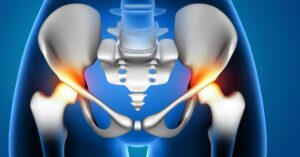 Kalçada Kireçlenme Belirtileri Kalçada Kireçlenme Belirtileri