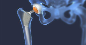 Kalça Protezi Ameliyatı Sonrası Kalça Protezi Ameliyatı Sonrası