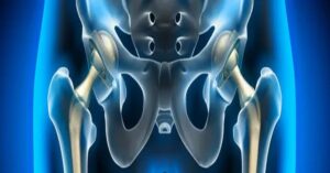 Kalça Protezi Ameliyatı Sonrası Kalça Protezi Ameliyatı Sonrası