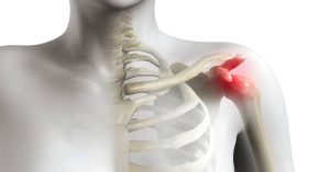 Omuz Sıkışması Sendromu Omuz Sıkışması Sendromu