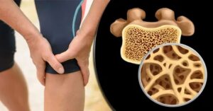 Kemik Erimesi Nedir? Kemik Erimesi Nedir?