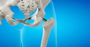 Robotik Kalça Ameliyatı Robotik Kalça Ameliyatı