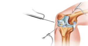 Artroskopi Ameliyatı Artroskopi Ameliyatı