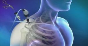 Artroskopi Ameliyatı Artroskopi Ameliyatı