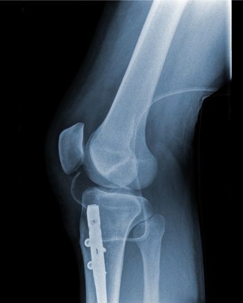 Knee Replacement Surgery