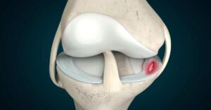 Menisküs Yırtığı Ameliyatı Menisküs Yırtığı Ameliyatı