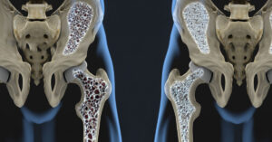 Kemik Erimesi Tedavisi Kemik Erimesi Tedavisi