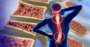 Kemik Erimesi Tedavisi Kemik Erimesi Tedavisi