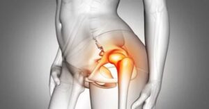 Kalça Çıkığı Ameliyatı Kalça Çıkığı Ameliyatı