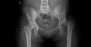 Kalça Kırığı Ameliyatı Kalça Kırığı Ameliyatı