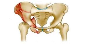 Kalça Kırığı Ameliyatı Kalça Kırığı Ameliyatı