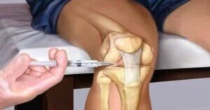 Diz Eklemi Kireçlenmesi Diz Eklemi Kireçlenmesi