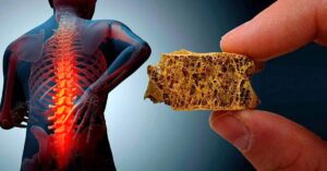 Kemik Erimesi Hastalığı Nedir? Kemik Erimesi Hastalığı Nedir?