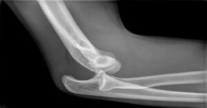 Dirsek Çıkığı Dirsek Çıkığı