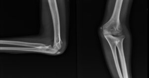 Dirsek Çıkığı Nedir? Dirsek Çıkığı Nedir?