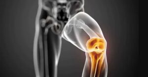 Diz Protezi Ameliyatı Nasıl Yapılır? Diz Protezi Ameliyatı Nasıl Yapılır?