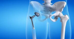 Kalça Protezi Nedir?